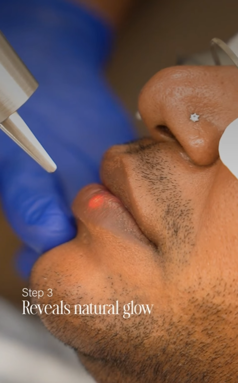 Laser Hair Reduction Treatment